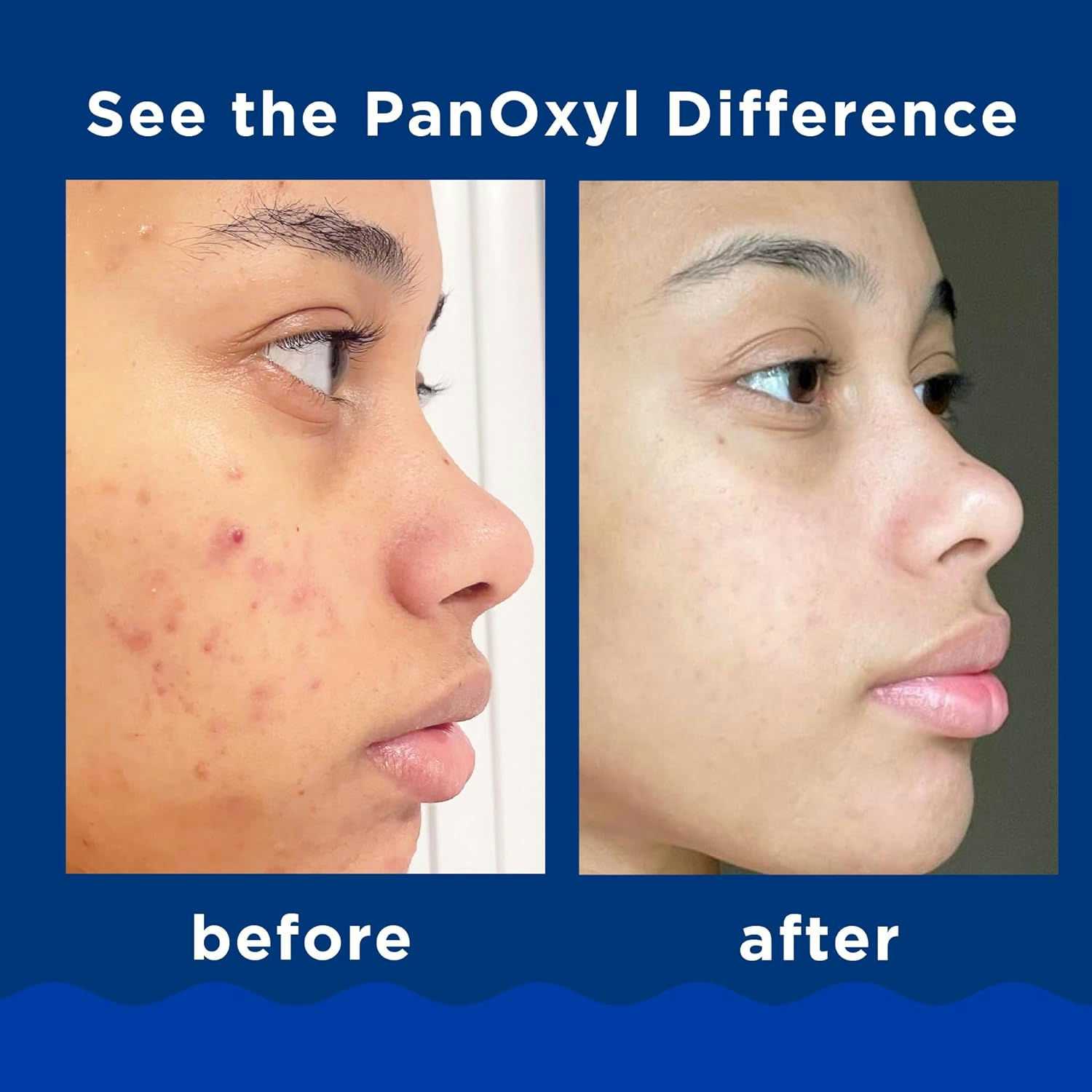 PanOxyl Foaming Acne Wash